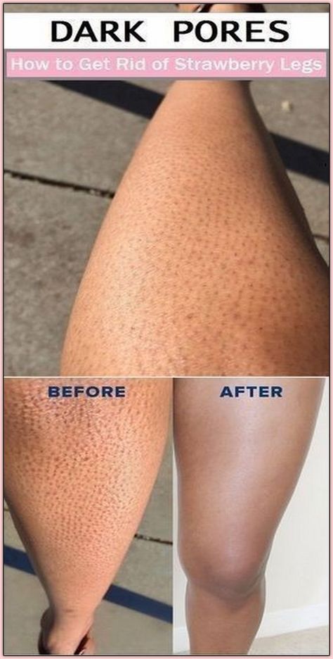 How to Get Rid of Strawberry Legs Body Maintenance, Strawberry Legs, Sharon Stone, Natural Therapy, Beauty Remedies, Body Makeup, Beauty Tricks, Running Tips, Skin Treatments