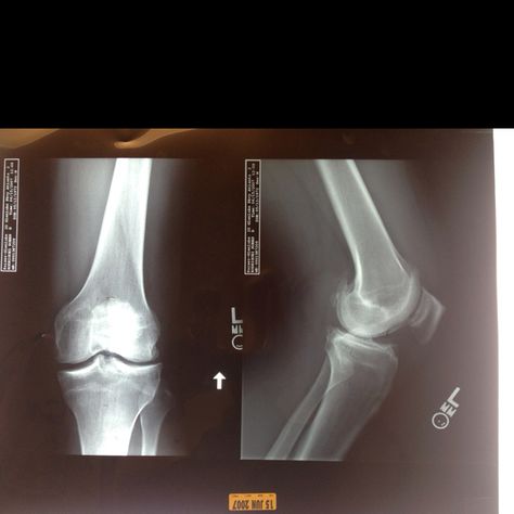 Torn ACL and lateral meniscus Mcl Tear, Acl And Meniscus Surgery, Acl Injury X Ray, Torn Ligament In Ankle, Torn Ligament In Knee, Torn Acl, Acl Surgery, Acl Tear, Slam Dunk