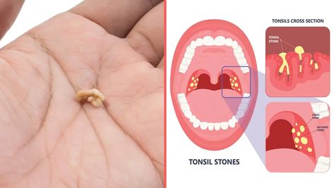 4 Things That Cause Tonsil Stones (And How to Prevent Them) Tonsil Stone Removal, Swollen Tonsils, Homemade Mouthwash, Throat Infection, Indian Family, How To Prevent Cavities, Medical Anatomy, Ingrown Toe Nail, Sinus Infection