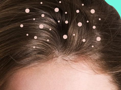 What Causes Dandruff? The Truth Behind 9 Common Dandruff Myths | SELF What Causes Dandruff, Dandruff Causes, Dandruff Solutions, How To Treat Dandruff, Home Remedies For Dandruff, Dandruff Remedy, Getting Rid Of Dandruff, Hair Dandruff, Anti Dandruff Shampoo