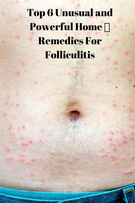 Folliculitis is a painful infection of the hair #follicles caused by bacteria #Staphylococcus aureus penetrating inside the pores. Staphylococci Bacteria Remedies, Staphylococci Bacteria Infection On Skin, Infected Hair Follicle, How To Become Healthy, First Aid Tips, Natural Remedies For Migraines, Allergy Remedies, Chest Congestion, Dry Skin Remedies