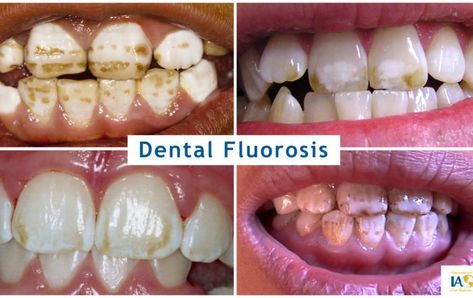 examples of damage to teeth, including staining and mottling ranging from mild to severe, from dental fluorosis caused by fluoride Dental Hygiene Month, Dental Fluorosis, Dental Posters, Pasta Dental, Dental Hygiene, Medical Students, Glow Up?, Benefits, Ethnic Recipes