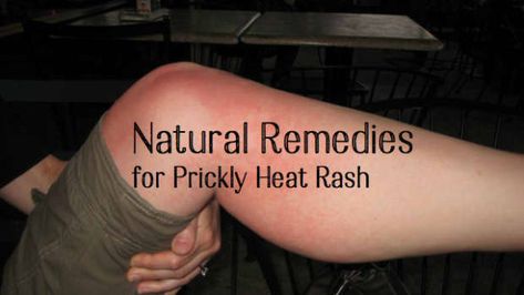 Treating Heat Rash, Heat Rash Remedy, Home Remedies For Rashes, Prickly Heat Rash, Rashes Remedies, Teeth Remedies, Thinning Hair Remedies, Prickly Heat, Heat Rash