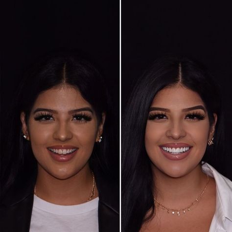 Perfect Teeth Braces, Perfect Teeth Smile, Perfect Smile Teeth, Silky Black Hair, Braces Smile, Teeth Remedies, Pretty Teeth, Botox Lips, Teeth Whitening Homemade