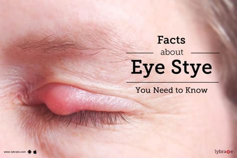 What Causes A Stye In Your Eye, How To Heal A Stye Fast, Stye Remedies Fast How To Get Rid, Sty In Eye Remedies, Eye Sty, Stye Remedies Fast, Stye Causes, Stye Remedies, Stye Remedy