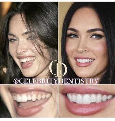 Teeth Makeover, Perfect Smile Teeth, Teeth Aesthetic, Dental Bonding, Veneers Teeth, Beautiful Teeth, Cosmetic Injectables, Perfect Teeth, Nice Teeth