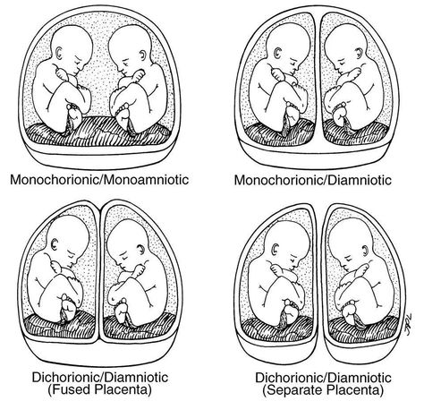 Pregnancy Ob Ultrasound, Getting Pregnant With Twins, Midwifery Student, Multiple Births, Diagnostic Medical Sonography, Student Midwife, Multiples Baby, Nurse Jackie, Ectopic Pregnancy