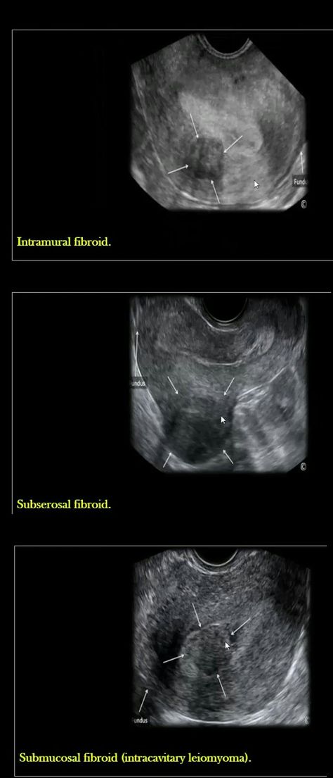 Obgyn Sonography Student, Ultrasound Technician Student, Uterus Ultrasound, Sonography Humor, Ultrasound Humor, Ob Ultrasound, Ultrasound Student, Gyn Ultrasound, Diagnostic Medical Sonography Student