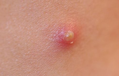 A pustule is a inflamed papule with a white or yellow center containing pus. Pustules Acne Remedies, Essential Oil For Boils, Pustules Acne, Skin Boil, Best Chemical Peel, Clear Skin Routine, Spa Ideas, Types Of Acne, Acne Causes