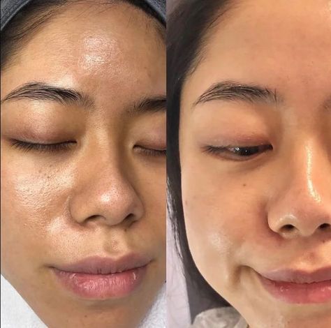 Bb Glow Facial, Camouflage Tattoo, Bb Glow, Stretch Mark Removal, Skin Science, Beautiful Lashes, Minimize Pores, All Skin Types, Pollution