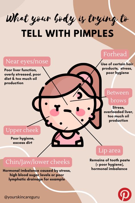 Pimples Reasons Faces, Pimple Face Guide, Why You Get Acne In Certain Areas, Causes Of Pimples On Face, Placement Of Pimples Meaning, What Pimples In Different Places Means, Reasons Of Pimples On Face, What Ur Acne Mean, Reasons For Pimples On Face