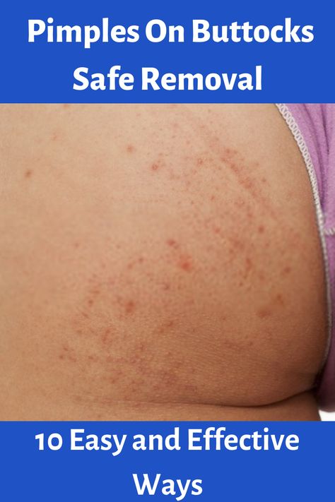 Pimples On Buttocks Safe Removal - 10 Easy and Effective Ways How To Get Rid Of Pimples On Buttocks, How To Get Rid Of Buttocks Acne Quick, How To Get Rid Of Bumps On Buttocks, How To Get Rid Of Boils In Private Area, How To Get Rid Of Buttocks Acne, Leg Pimples, Bumps On Legs, How To Treat Pimples, Buttocks Acne