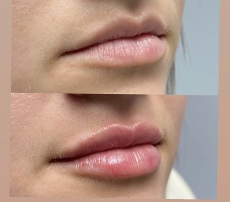 Lip Injections Natural, Lip Filler Inspo Natural, Minimal Lip Fillers, Light Lip Filler, Lip Filler Natural, Natural Looking Lip Fillers, Perfect Lips Natural, Subtle Lip Filler, .5 Lip Filler