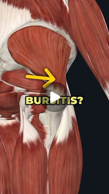 Dr. Adam McCluskey PT, DPT on Instagram: "💥Told You Have Hip Bursitis? Watch this…💥 (Start my Bulletproof Hip Program @theptinitiative Bio Link!...) . 👋In 30 days I can help you eliminate years of chronic hip tightness and pain and get back to working out pain free! Link in @theptinitiative bio to download my Bulletproof Hip Program! —— 🔑Hip Bursitis is a very common diagnosis for outer hip pain. While it does happen, many times I find that it’s actually a Gluteal Tendinopathy! —— ➡️Both can be painful laying on your side, but one giveaway for me is when patients say they were told to do clamshells and this seemed to aggravate things more. — ✅If you are dealing with outer hip pain, more specifically gluteal tendinopathy, this is my method for fixing this issue for good! ————— Need help Exercises For Bursitis Hip Pain, Hip Pain Stretches, Hip Bursa, Hip Imbalance, Bursitis Hip Relief, Gluteal Tendinopathy, Hip Tightness, Bursitis Hip, Hip Exercises