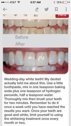 Whiten Teeth With Baking Soda, Baking Soda Teeth, Baking Soda Teeth Whitening, Teeth Whitening Homemade, Teeth Whitening Remedies, Teeth Whitening Diy, Charcoal Teeth Whitening, Whiten Teeth, Diy Products