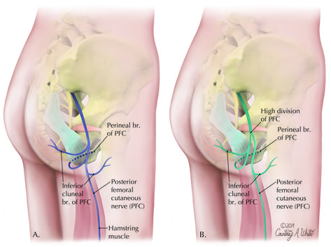 Pinched Nerve In Buttocks, Femoral Nerve Pain Relief, Pelvic Floor Dysfunction Exercises, Pelvic Congestion Syndrome, Body Muscle Anatomy, Hip Anatomy, Femoral Nerve, Nurse Skills, Muscle System