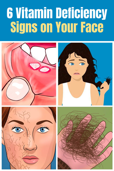 Signs of vitamin deficiency on the face may include a pale complexion, dry or flaky skin, acne or breakouts, angular cheilitis, dark circles, and premature aging, highlighting the importance of proper nutrition for skin health. #nails #nailhealth #vitamindeficiency #brittlenails Signs Of Mineral Deficiencies, Vitamin Deficiency Symptoms Chart, Vitamin Deficiency Chart, Calcium Deposits On Face, Vitamin Deficiency Symptoms, Angular Cheilitis, Health Nails, Mineral Deficiency, Pale Complexion