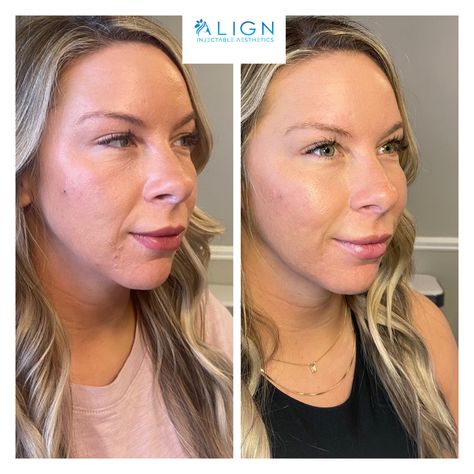 Before and after midface cheek filler Cheek And Chin Filler, Cheekbone Filler, Mid Face Filler, Jaw And Cheek Filler, Medial Cheek Filler, Cheek Fillers, Dermal Fillers, Plastic Surgery, Surgery