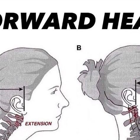 Fix Your Back Pain on Instagram: "💥𝐅𝐨𝐫𝐰𝐚𝐫𝐝 𝐇𝐞𝐚𝐝💥 —— 🔎Forward head posture describes a position where the head translates forward on the trunk creating extension of the upper neck and flexion of the lower neck (see image). - 🧠Forward head is not really a concern in of itself (although many on social media would lead you to believe otherwise) as the mechanical stress associated with this position is very manageable for the structures of the cervical spine. However, when the neck in Chin Tuck, Forward Head Posture, Cervical Spine, The Trunk, Sciatica, See Images, Neck Pain, The Head, Fitness Diet