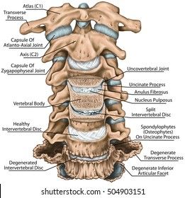 Cervical Spine Both Vertebral Arteries Transverse Stock Illustration 505306087 Lumbar Disc, Back Bone, Disk Herniation, Bulging Disc, Human Body Anatomy, Spine Health, Spine Surgery, Muscle Anatomy, Human Skeleton