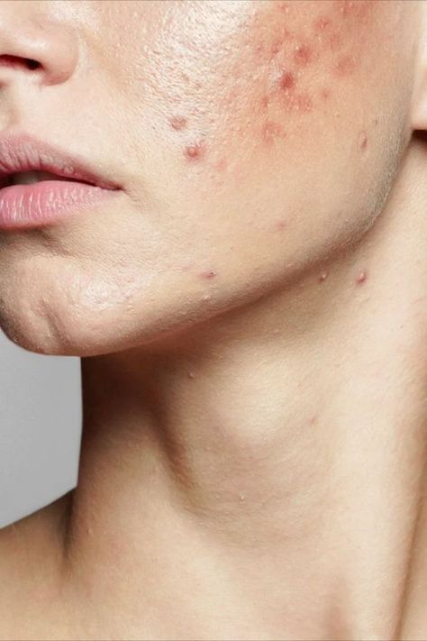 #Acne_Aesthetic #Acne_Photos #Skin_Breakouts #Remove_Skin_Tags_Naturally Acne Photos, Acne Aesthetic, Acne Positivity, Face Map, Skin Breakouts, Remove Skin Tags Naturally, Face Mapping Acne, Stubborn Acne, Acne Beauty