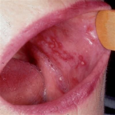 Lichen Planus | British Association of Oral and Maxillofacial Surgeons Pemphigus Vulgaris, Skin Rashes Pictures, Lichen Sclerosis, Lichen Planus, Oral Pathology, Canker Sore, Health Nut, Skin Diseases, Dental Hygiene