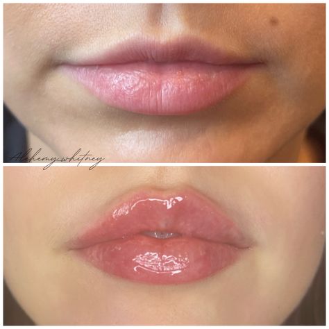 Picture of a girl’s lips before and after filler 0 5 Ml Lip Filler, 0.5ml Lip Filler Before And After, 0.5 Ml Lip Filler Before And After, Lip Filler, Lip Fillers, Glow Up?, Mls, Lips, Quick Saves