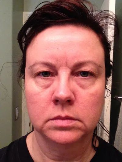 52 Yr Old Wants a Refreshed, Not Tired, Look! Lower Face/Neck Lift... Lower Face Lift, Tired Look, Tired Face, Sagging Face, Mommy Makeover, Neck Lift, Before After Photo, Eye Wrinkle, Face Lift