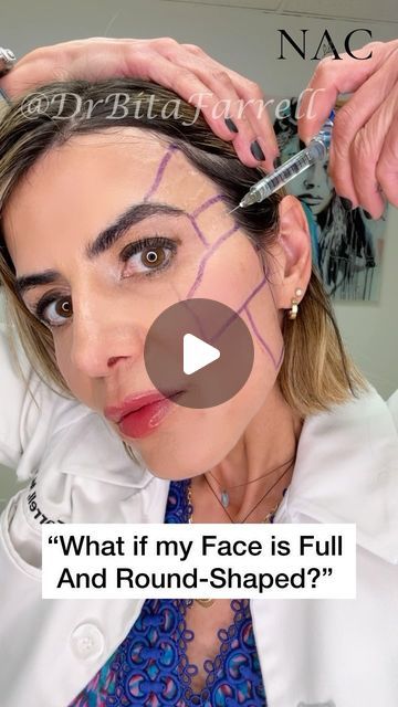 Dr. Bita Zadeh Farrell on Instagram: "All face shapes are beautiful.  Period!  As the face matures and ages, there can be volume loss in the lateral part of the face - in the temple, pre-auricular (in front of ear), and jawline.  This can create a central or mid face heaviness.   Oval or heart shaped faces are longer than they are wide, with the cheekbones being the widest part of the face; which gives for a more contoured appearance.  Adding dermal fillers and/or Biostimulators to the lateral part of the face can help balance and add definition to a rounded or mid-heavy face.   #facialbalancing #facialharmonization #faceshape #drbitafarrell #naturalaestheticscenter" Cheek Fillers Round Face, Cheekbone Filler Before And After, Face Balancing Fillers, Heart Shaped Faces, Face Fillers, Botox Filler, All Face Shapes, Botox Fillers, Heart Face