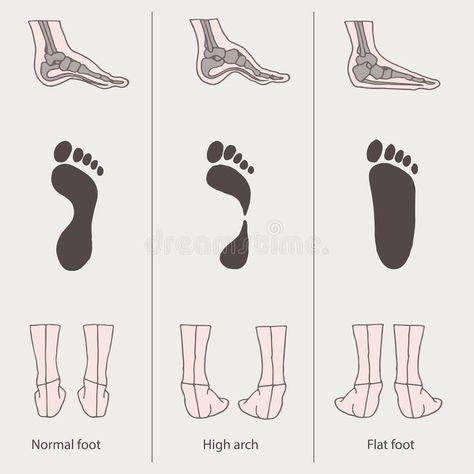 Flat foot, high arch. Medical illustration, flat foot, high arch , #spon, #high, #foot, #Flat, #arch, #flat #ad Flat Feet Exercises, Shoes For High Arches, Foot Anatomy, Fallen Arches, Foot Exercises, Health Hacks, Thai Massage, Foot Health, Medical Illustration