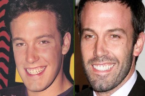 Ben There Done That-Celebrities who have fixed their teeth Celebrities With Veneers, Braces Humor, Celebrity Teeth, Dental Makeover, Celebrity Smiles, Denture Implants, Laser Teeth Whitening, Fake Teeth, Perfect Teeth