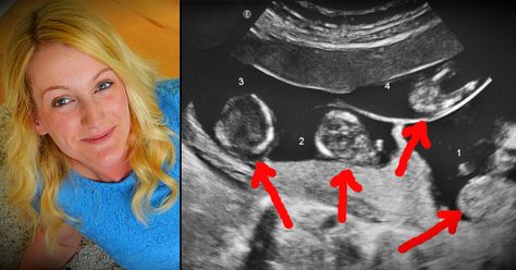 This mom wasn't supposed to be able to get pregnant. Then she naturally conceived miracle quadruplets from 4 fertilized eggs, making medical history! Identical Quadruplets, Matthew Davis, Ultrasound Technician, Bump Pictures, Multiples Baby, Baby Ultrasound, Ultrasound Pictures, Newborn Mom, Get Pregnant