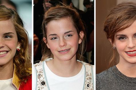 ortodoncia British Actresses, Emma Watson, Braces, The Process, Buzzfeed, You Changed, Actresses, Canning, Celebrities