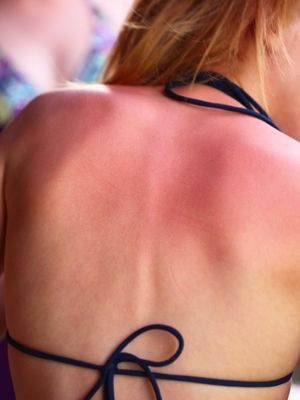 8 tricks for surviving weekend sunburn Sunburn Remedies, Used Tea Bags, Razor Burn, Reduce Swelling, Skin Natural Remedies, Skin Remedies, Chapped Lips, Tea Bags, Blood Vessels