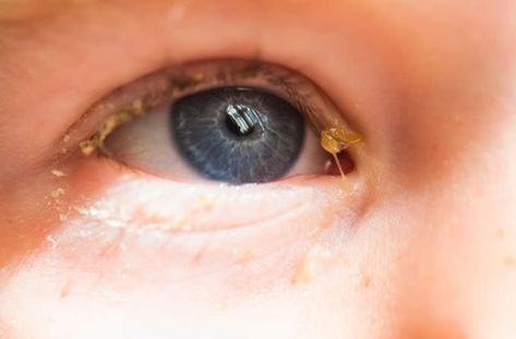 Home Remedy For Eye Infection, Crusty Eyes Remedies, Newborn Eye Discharge, Watery Eyes Remedy, Eye Infection Remedies, Goopy Eyes, Stye Remedy, Crusty Eyes, Eye Medicine