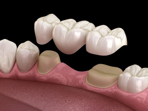 Tooth Bridge, Dental Bridge Cost, Dental Wallpaper, Dental Images, Dental Posters, Partial Dentures, Human Teeth, Dental Facts, Tooth Replacement