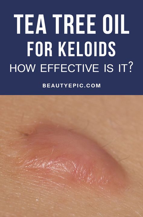 Wounds are usually surrounded by scar tissues and overgrowth of scar tissues is known as keloid. Here we shall discuss its using of tea tree oil for keloids Tea Tree Oil Benefits, Body Improvement, Tea Tree Oil Uses, Scar Remedies, Tea Tree Oil Face, Oils For Scars, Tea Tree Oil For Acne, Home Remedy For Cough, Cold Sores Remedies