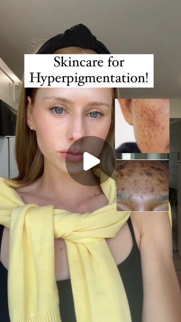 Maja on Instagram: "✨As promised I will be giving skincare recommendation for hyperpigmentation!   ✨Starting off strong with Hydroquinone! I Know many people are nervous to use a hydroquinone cream but when used properly and monitored by a skin specialist the results are stunning!   I linked the product in my bio ✨  #hydroquinone #hyperpigmentationtreatment #melasmatreatment #hyperpigmentation #skincaretips   What do you struggle with?" Hydroquinone 4% Before And After, Phenol Peel, Hyperpigmentation Mask, Skin Care Hyperpigmentation, Dermatologist Skin Care, Hydroquinone Cream, Skin Care Specialist, Skin Specialist, What To Use