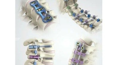 Solutions Acdf Surgery, Mecha Reference, Nurse Education, Spinal Fusion Surgery, Orthotics And Prosthetics, Cervical Disc, Orthopedic Brace, Spinal Fusion, Spinal Decompression