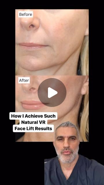 Amir M Karam, MD on Instagram: "A lot of people ask how I achieve such natural results with my Vertical Restore so I’m here to break it down. 

Something that Neda and all of my other patients have in common is that they do not look like they went under the knife for a full facial rejuvenation. At my practice, that is the goal. If you are looking for extreme change and unrecognizable enhancements, you won’t find that in my office. 

The beauty of the Vertical Restore is that you look at yourself in the mirror, and you can still recognize yourself, but you look like a younger version. Isn’t that what everyone wants as we age? 

Remember, skin related changes such as pigmentation and complexion can often be attributed to my patients acid dedication to the Trifecta. Shape, laxity, skin. Three Vertical Restore Facelift, Mini Face Lift, Under The Knife, Facial Rejuvenation, Flat Bread, Face Lift, My Office, A Lot Of People, Instagram A