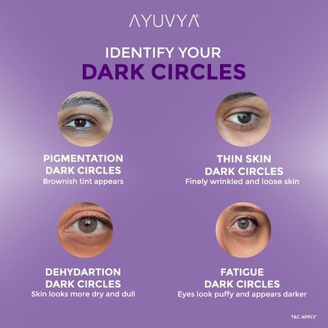 What is your Dark circle Type?👀 Swipe right for the ultimate Solution💚👉🏻 . . . Get yours from the Link in Bio🔗🛍️ . (under eye gel, dark… | Instagram Vitamin E For Dark Circles Under Eyes, Dark Circles Under Eyes Skincare, Eyes Massage For Dark Circles, Dark Circles Under Eyes Massage, Dark Cycles Under Eyes, Dark Circles Under Eyes, Loose Skin, Eye Gel, Eye Care