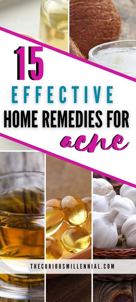 15 Most Popular Acne Home Remedies: Do They Work? Remedy For Acne, Clear Acne Fast, Acne Home Remedies, Clear Up Acne, Treat Acne Naturally, Back Acne Remedies, Remedies For Acne, Diy Acne, Natural Acne Remedies