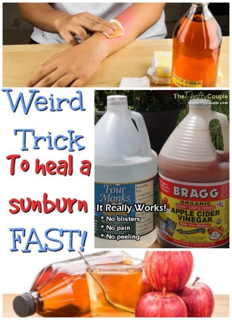 How to Heal A Sunburn (No blisters, No Pain and No peeling) and Turn Into A Tan Naturally and Frugally with Vinegar - It Really Works - The Thrifty Couple Sunburn Face Remedy, Sunburn Remedies Apple Cider Vinegar, Severe Sunburn Relief, Sunburn Relief Instant Diy, Vinegar For Sunburn Relief, How To Heal Sunburn Fast, Sun Burn Remedy Overnight, Home Remedy For Sunburn, Sun Burn Remedy