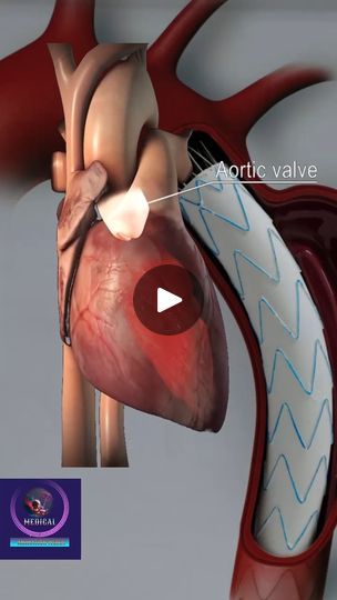 193K views · 3.3K reactions | Aortic Valve - 3D animation #heartvalve #medical #animation #foryou #fpyシ | Medical Animation Media | Medical Animation Media · Original audio Jugular Venous Pressure, Medical Animation, Heart Valves, Medical Videos, 5th Grade Science, Video Animation, 5th Grade, 3d Animation, Medical