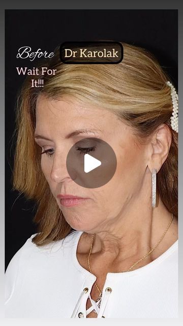 Dr. Mark Karolak, DO, FAOCO on Instagram: "This #gorgeous 59 year old patient came to visit me in New Jersey from Tennessee. I used my deep plane facelift and neck lift technique to highlight her natural beauty!!! I love that her results look elegant and complimentary to her features. The temporal lift helped balance her face by tightening the temple area, upper part of the cheek, and outside portion of her brows. I am so grateful that she let me share her photos! I absolutely love her results, and so does she!!! 

There’s a fine line between too much and not enough. The goal is to look better, not different.

#deepplanefacelift #facelift  #plasticsurgery #drkarolak #bestfacelift #verticalfacelift #newjersey #monmouthcounty #faceliftbeforeandafter #newyorkcity #nj #faceliftbeforeandafterpi Deep Plane Facelift, Deep Plane Facelift Before And After, Facelift Before And After, Face Lift Surgery, Neck Lift, Plastic Surgery, New Jersey, Natural Beauty, Tennessee