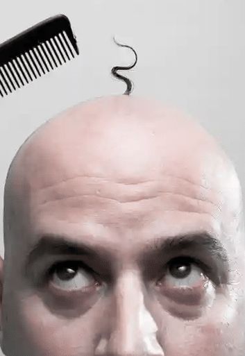 How can I avoid going bald in Australia? Well, men and women have the same question. Let us dissect what you can do to prevent hair loss. Going Bald, What You Can Do, How Can, Antonio Mora Artwork, You Can Do, Halloween Face Makeup, I Can, Herbs, Australia