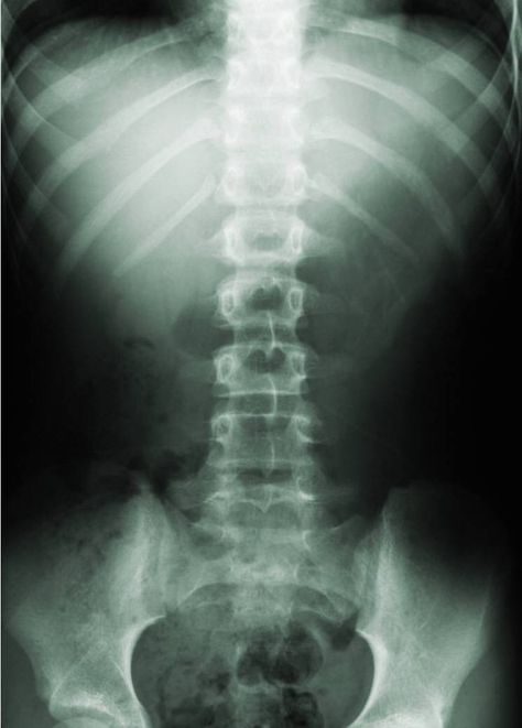 Have a straight Spine. Apologia Biology, Rectus Abdominis, Xray Art, Inversion Table, Doctor Of Chiropractic, Spinal Injury, Pediatric Care, Personal Injury Lawyer, Chiropractic Care