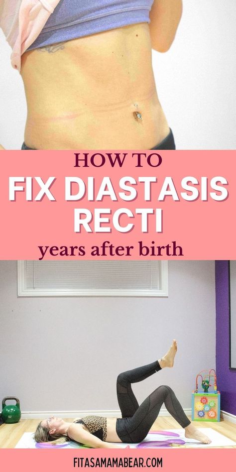 There’s no “expiry date” on when you can work on healing from pregnancy. Use these diastasis exercises and tips to help heal your abs no matter where you are in your postpartum journey @fitasamamabear #diastasis #diastasisrecti #postpartum #postpartumhealing Diastasis Recti Repair Exercises, Healing Diastasis Recti Years Later, Ab Repair Diastasis Recti, Ab Separation Diastasis Recti, Diastasis Recti Exercises While Pregnant, Diastasis Recti Repair, What Is Diastasis Recti, Healing Diastasis Recti, Diastasis Recti Exercises