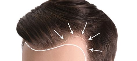 During this step, the doctor will make a final review in regards to the total number of hair follicles to be removed, the number of hair shafts in the follicles and the broadness of the shafts. The sites and density of the hair transplantations are determined after the patient’s expectations are considered. Hair Growth Kit, Laser Hair Reduction, Fue Hair Transplant, Hair Transplant Surgery, Best Hair Transplant, Hair Care Brands, Skin Clinic, Hair Reduction, Unwanted Hair Removal