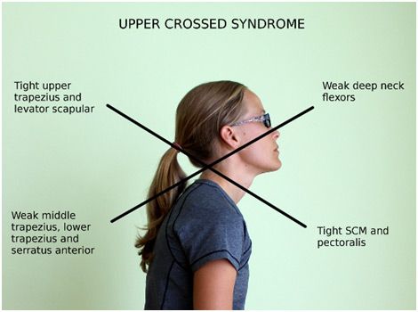 Upper Cross Syndrome, Trapezius Muscle, Posture Fix, Text Neck, Therapy Exercises, Therapy Practice, Forward Head Posture, Reflexology Chart, Sports Therapy